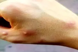 تصاویر ضایعه پوستی اولین بیمار مبتلا آبله میمونی در ایران/ نکات مهمی که باید درباره آبله میمونی بدانیم