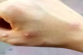 شباهت علائم آبله میمونی و آبله مرغان