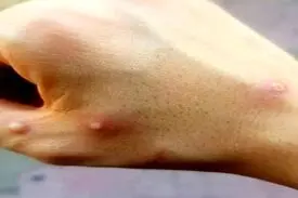 شباهت علائم آبله میمونی و آبله مرغان