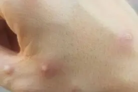 شباهت علائم آبله میمونی و آبله مرغان