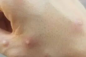 شباهت علائم آبله میمونی و آبله مرغان