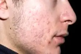 آکنه در نوجوانی نشانه سلامتی است