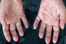 بهبودی بیمار مبتلا به آبله‌ میمونی در ایران