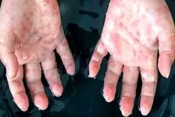 بهبودی بیمار مبتلا به آبله‌ میمونی در ایران