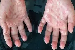 بهبودی بیمار مبتلا به آبله‌ میمونی در ایران