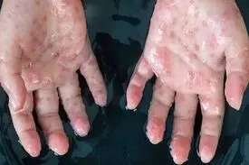 بهبودی بیمار مبتلا به آبله‌ میمونی در ایران