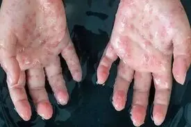 بهبودی بیمار مبتلا به آبله‌ میمونی در ایران