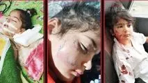 حمله سگ به دوقلوها، جان یکی از آنها را گرفت / تکرار تراژدی کودک‌کشی سگ‌ هار