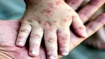 جان باختن بیش از ۲۰ تن در پی ابتلا به سرخک در افغانستان