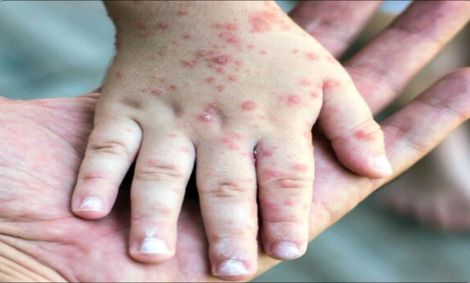 جان باختن بیش از ۲۰ تن در پی ابتلا به سرخک در افغانستان