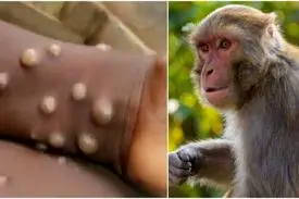 احتمال ورود آبله میمونی به ایران وجود دارد؟!