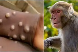 احتمال ورود آبله میمونی به ایران وجود دارد؟!