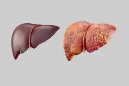 بمب خاموش در شهرهای آلوده/ آلودگی هوا کبد را هم نابود می‌کند