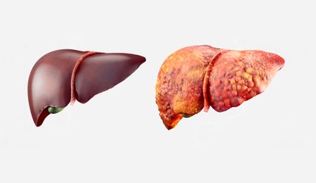 بمب خاموش در شهرهای آلوده/ آلودگی هوا کبد را هم نابود می‌کند