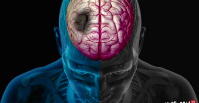 مقایسه علایم و نشانه های سکته قلبی و مغزی