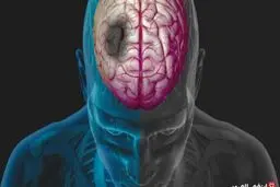مقایسه علایم و نشانه های سکته قلبی و مغزی