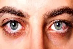 همه چیز درباره «آب مروارید» و راه‌های درمان آن