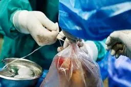 جزییات آیین‌نامه جدید اهدای عضو از فرد زنده