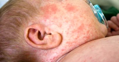 عارضه‌ فصل سرد که دشمن پوست است