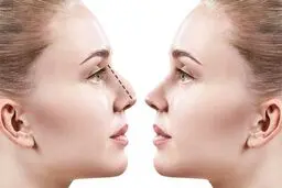 جراحی بینی با تضمین نقص عضو!