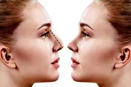 جراحی بینی با تضمین نقص عضو!