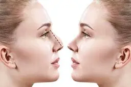 جراحی بینی با تضمین نقص عضو!