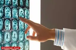 این گروه‌های خونی بیشتر در معرض سکته مغزی در سنین پایین هستند