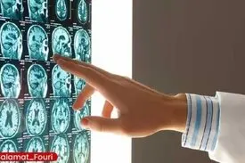 این گروه‌های خونی بیشتر در معرض سکته مغزی در سنین پایین هستند