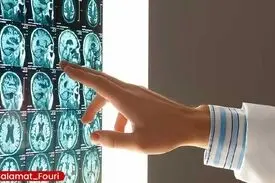 این گروه‌های خونی بیشتر در معرض سکته مغزی در سنین پایین هستند