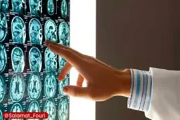 این گروه‌های خونی بیشتر در معرض سکته مغزی در سنین پایین هستند