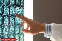 این گروه‌های خونی بیشتر در معرض سکته مغزی در سنین پایین هستند