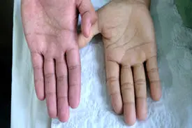 ۷ نشانه کم خونی که ممکن است ندانید / راه های درمان کم خونی