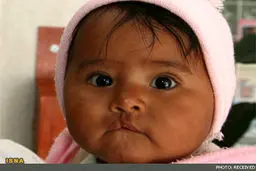 بهترین زمان درمان شکاف لب و کام چه زمانی است؟