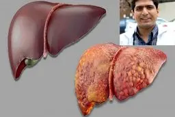 با کمک دانشمند ایرانی دانشگاه “جانز هاپکینز” انجام شد شناسایی مشکلات کلامی مرتبط با نارسایی کبدی با کمک هوش مصنوعی