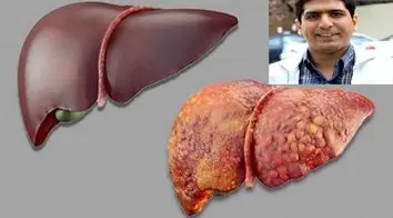 با کمک دانشمند ایرانی دانشگاه &#8220;جانز هاپکینز&#8221; انجام شد شناسایی مشکلات کلامی مرتبط با نارسایی کبدی با کمک هوش مصنوعی