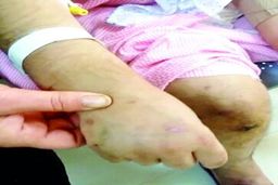 رد سوختگی بر تن «بیتا»