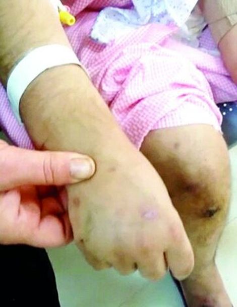 رد سوختگی بر تن «بیتا»