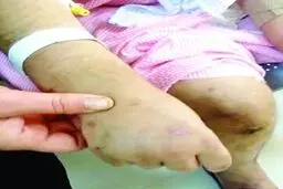 رد سوختگی بر تن «بیتا»