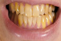 مصرف کدام خوراکی‌ها منجر به زرد شدن دندان‌ها می‌شود؟