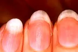 ۸ شکل و ظاهر غیر متعارف ناخن ها معرف ۸ مشکل بزرگ در سلامتی