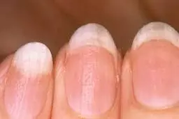 ۸ شکل و ظاهر غیر متعارف ناخن ها معرف ۸ مشکل بزرگ در سلامتی