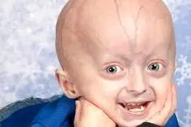 تخمین ۳میلیون «بیمار نادر» در ایران / هشدارِ ازدواج فامیلی و سن بالای بارداری