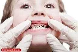 دانش آموزان ۱۲ ساله به طور میانگین ۲ دندان دائمی پوسیده دارند